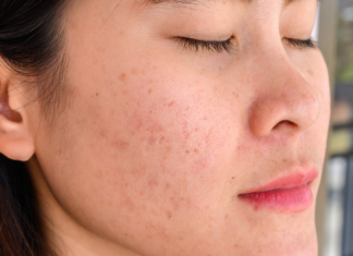 Best Facial for Clogged Pores: Treatments that Unclog Skin Best Facial for Clogged Pores