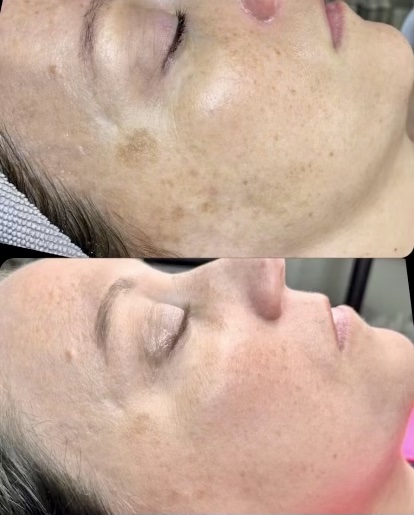 pumpkin facial benefits results before and after