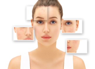 Best Facial for Acne Scars: Top Treatments for Scarring Best Facial for Acne Scars Top Treatments for Scarring