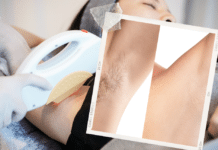 ¿La Depilación Láser Es Mejor Que la Depilación con Cera? Todo Lo Que Debes Saber Antes de Reservar What is Considered a Small Area for Laser Hair Removal chicago