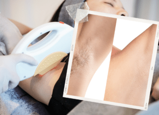 Laser Hair Removal vs. Waxing: Which is the Best Choice for Smooth Skin in Chicago? What is Considered a Small Area for Laser Hair Removal chicago