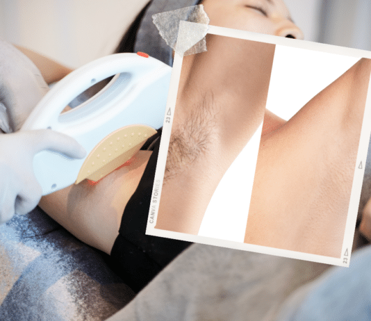 ¿La Depilación Láser Es Mejor Que la Depilación con Cera? Todo Lo Que Debes Saber Antes de Reservar What is Considered a Small Area for Laser Hair Removal chicago