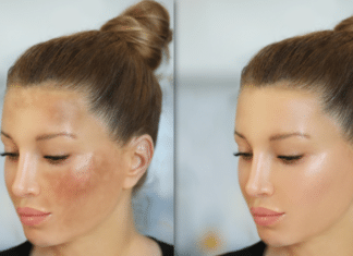 Does Microneedling Help Melasma? Details You Need to Know Does Microneedling Help Melasma chicago treatment