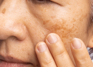 Best Facial for Melasma: How to Treat Hyperpigmentation Best Facial for Melasma How to Treat Hyperpigmentation