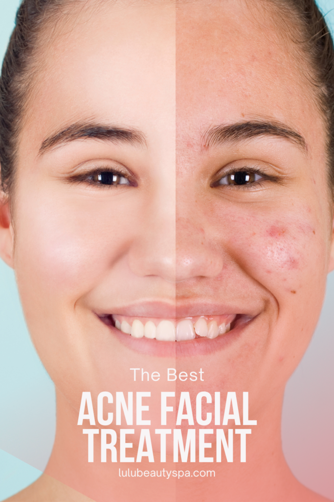 Best Acne Facial Treatment in Chicago for Acne Prone Skin Lulu Beauty Spa