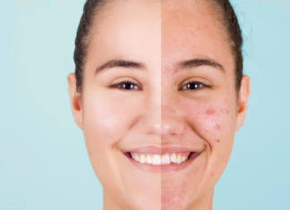The Best Ingredients for Acne Scars in Skincare Adult Acne at 30 Years Old: Causes & How to Treat It
