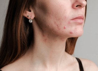 Best Night Cream for Hormonal Acne: Skincare Routine Best Night Cream for Hormonal Acne