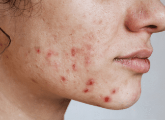 Does Dry Skin Cause Acne? How to Treat Both at the Same Time Does Dry Skin Cause Acne