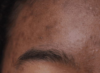 ¿La piel seca causa acné? Cómo tratar ambos al mismo tiempo Does Dry Skin Cause Acne treatment