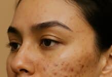 Acné Fúngico vs Acné Bacteriano: Cómo Saber la Diferencia y Evitar Gastar Dinero en Productos que No Funcionan Fungal Acne vs Bacterial Acne pin